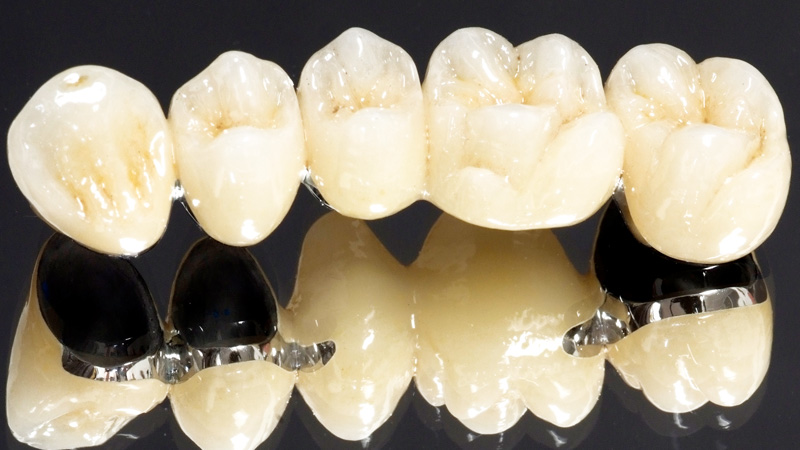 メタルセラミックス写真